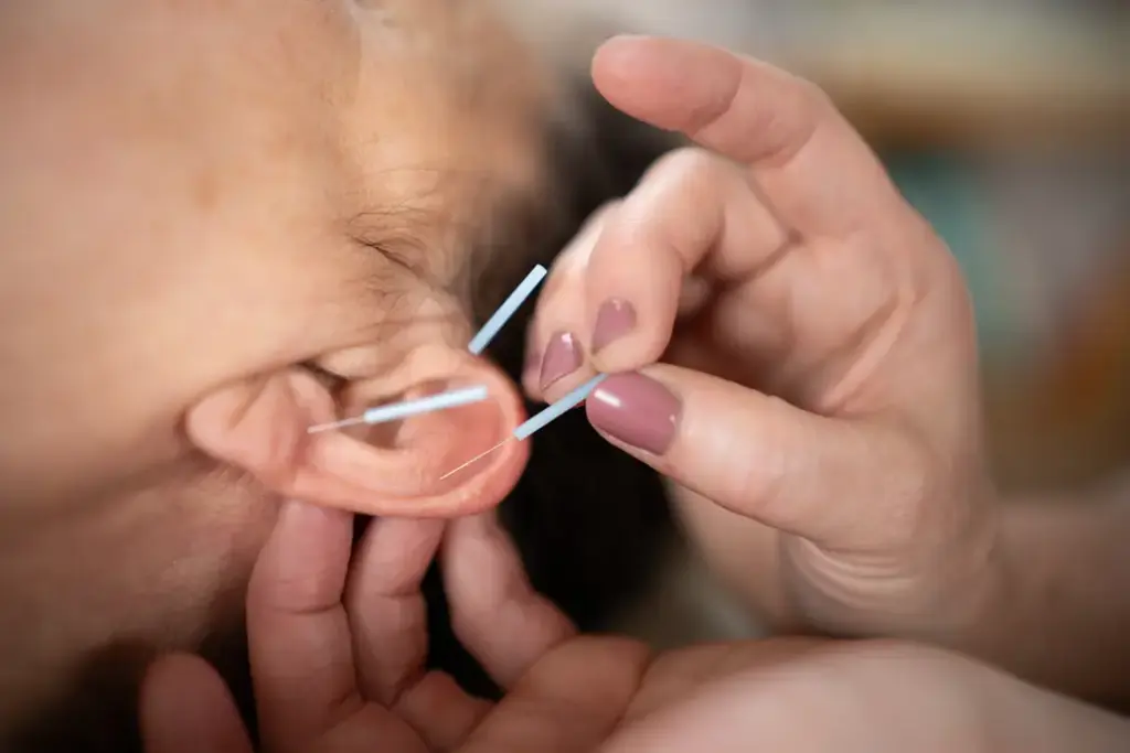 Behandlung Akupunktur